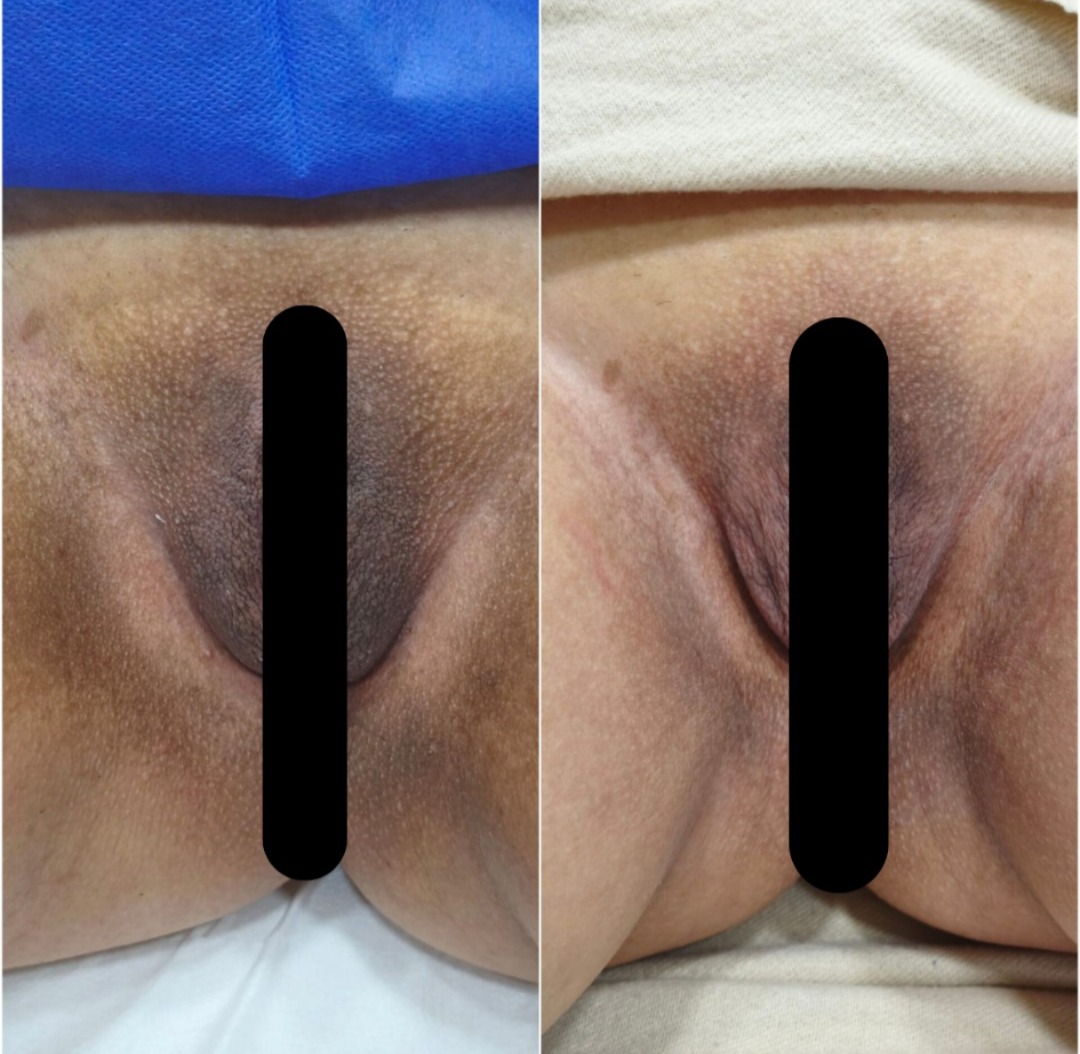 Antes y después de blanqueamiento íntimo con protocolo MeLine en SkinCenter Concepción — imagen editada para resguardar la privacidad de la paciente