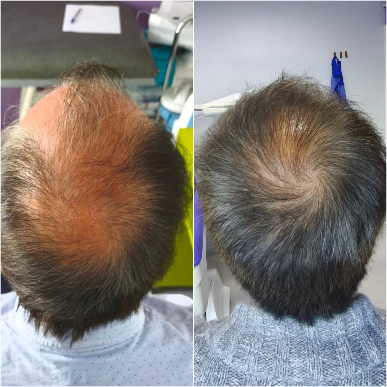 Implante capilar FUE antes y después a los 5 meses: densidad recuperada en la coronilla con 3.000 unidades foliculares — resultado del Dr. Georg Hübner