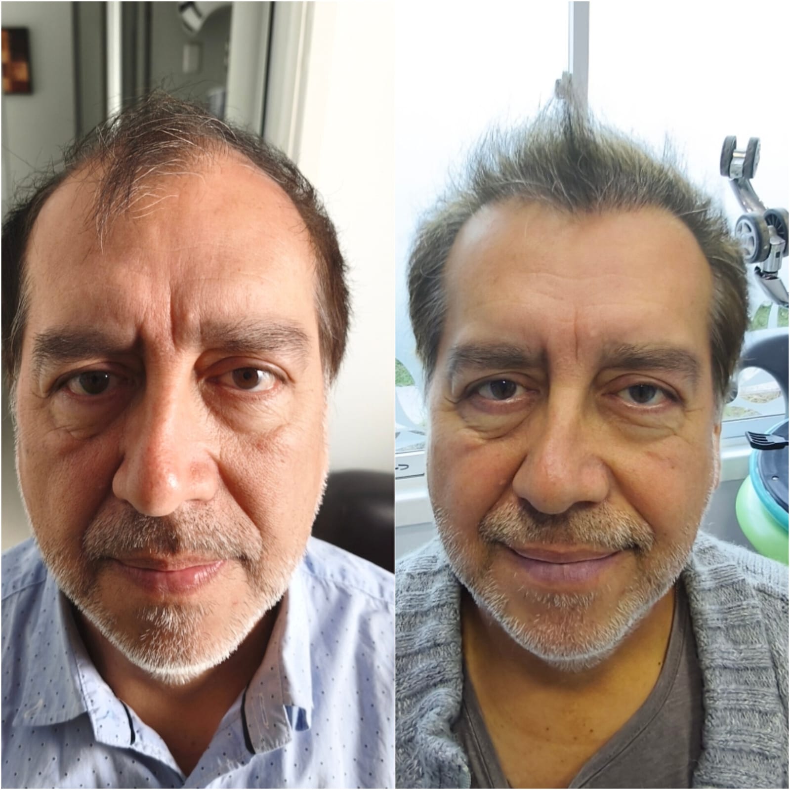 Implante capilar antes y después, 5 meses post operatorio: línea capilar frontal recuperada — resultado del Dr. Georg Hübner