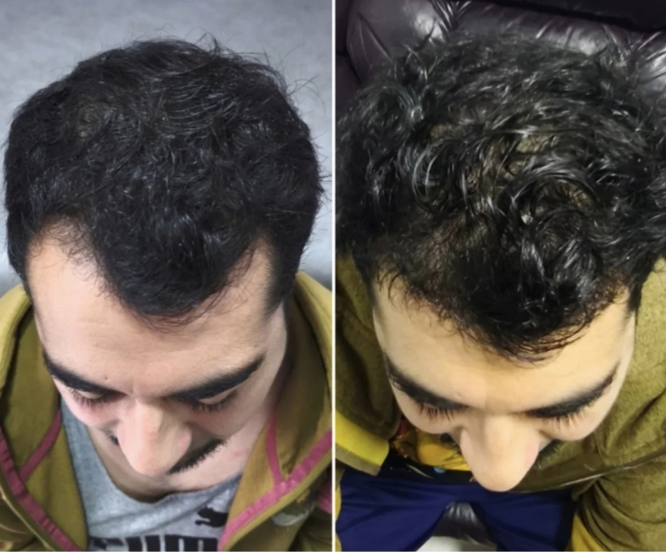 Implante capilar antes y después en hombre joven: línea frontal restaurada con técnica FUE — resultado del Dr. Georg Hübner