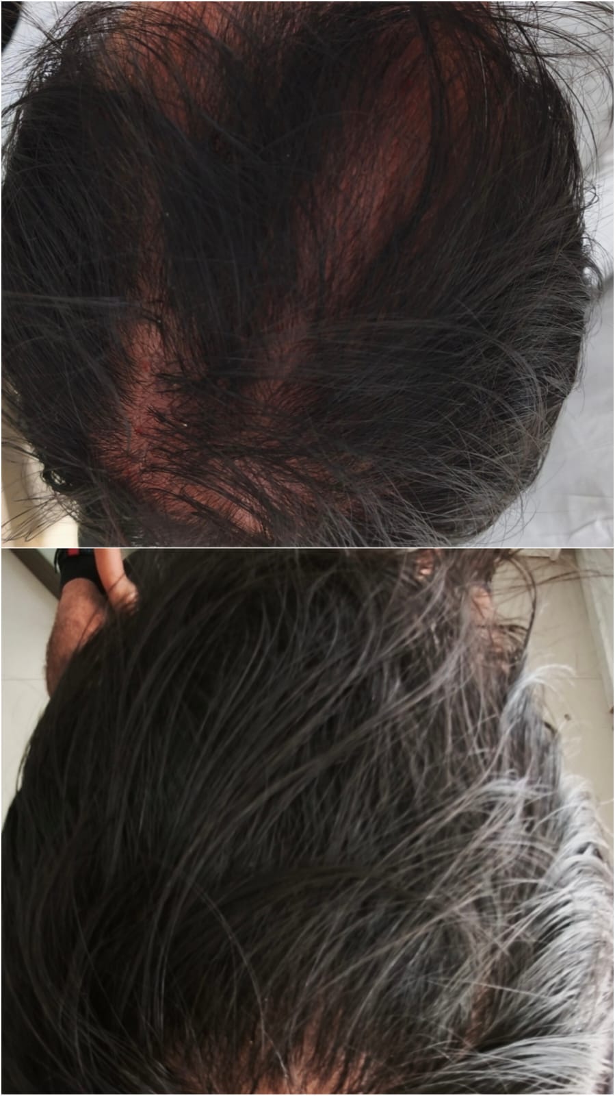Mesoterapia capilar antes y después de 4 sesiones: mayor densidad y grosor del cabello — resultado del Dr. Georg Hübner