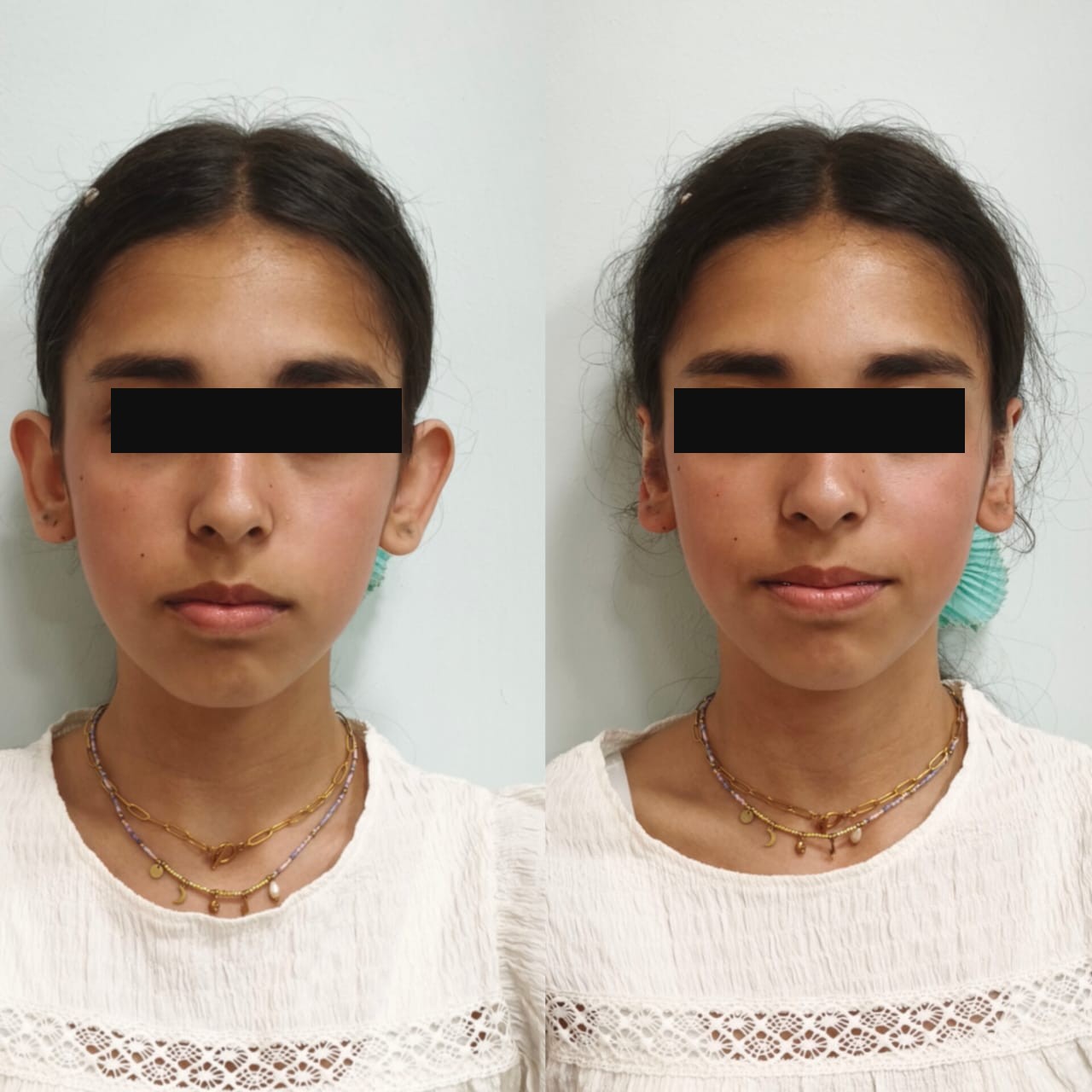 Otomodelación antes y después en SkinCenter Concepción: corrección de orejas prominentes en adolescente, resultado en una sola sesión