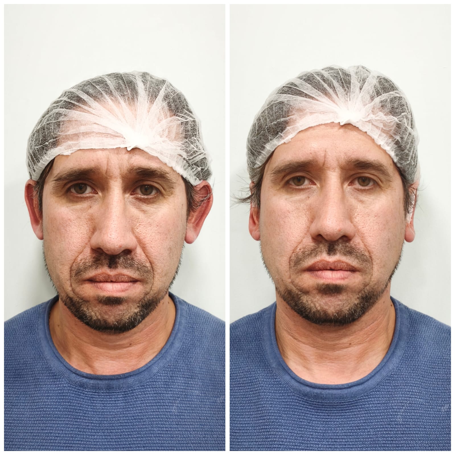 Otomodelación antes y después en SkinCenter Concepción: corrección de orejas en adulto, procedimiento con anestesia local