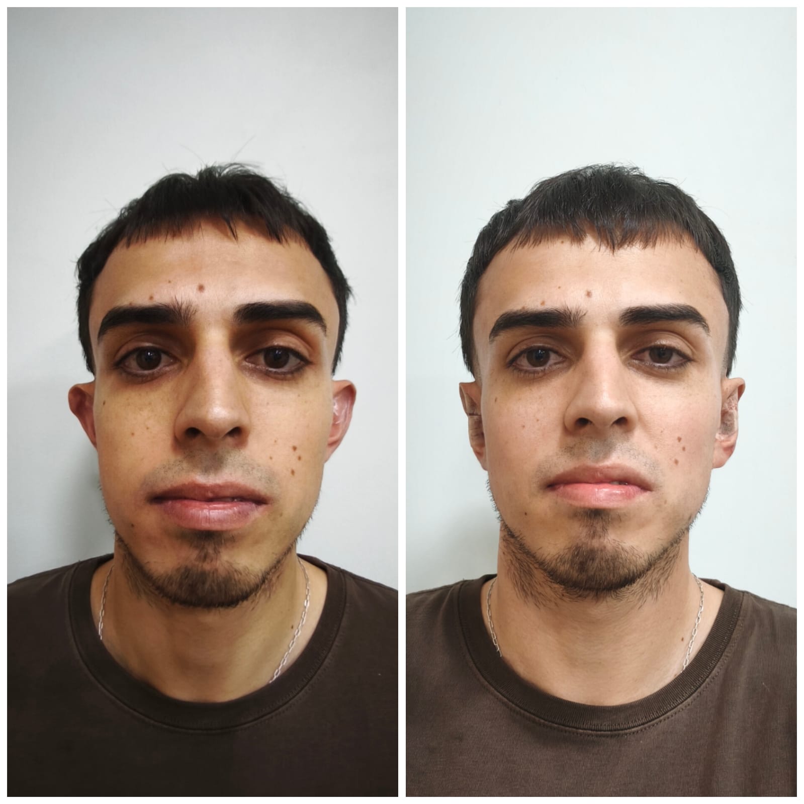 Otomodelación antes y después en SkinCenter Concepción: corrección de orejas prominentes en hombre joven