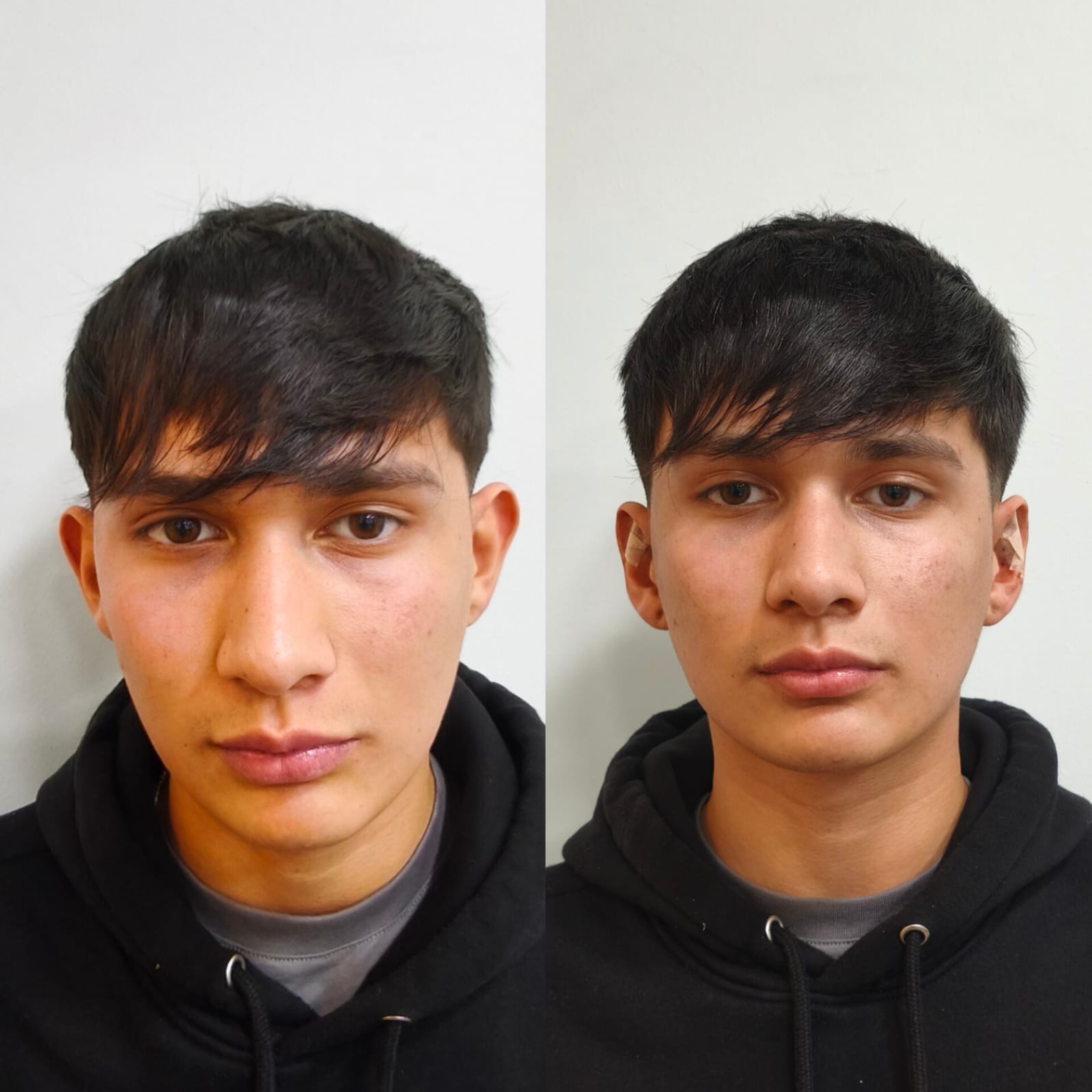Otomodelación antes y después en SkinCenter Concepción: corrección de orejas prominentes en paciente joven