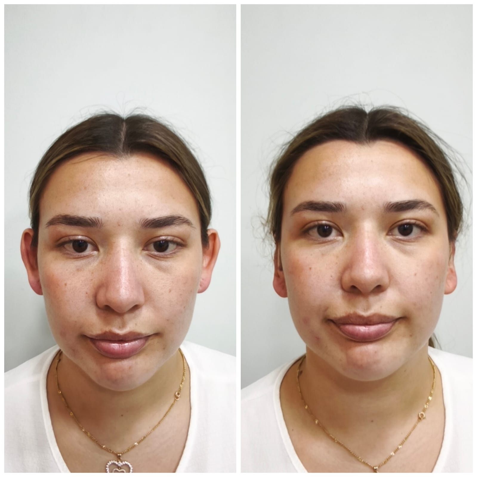 Otomodelación antes y después en SkinCenter Concepción: corrección de orejas en mujer adulta, sin cirugía tradicional
