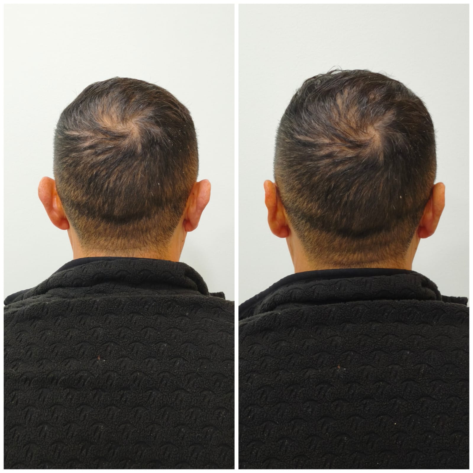 Otomodelación antes y después, vista posterior: simetría de orejas lograda en SkinCenter Concepción