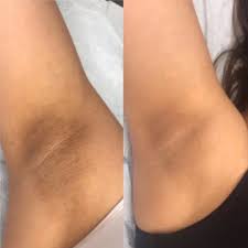 Pigmentación axilar antes y después — imagen referencial del blanqueamiento de axilas en SkinCenter Concepción