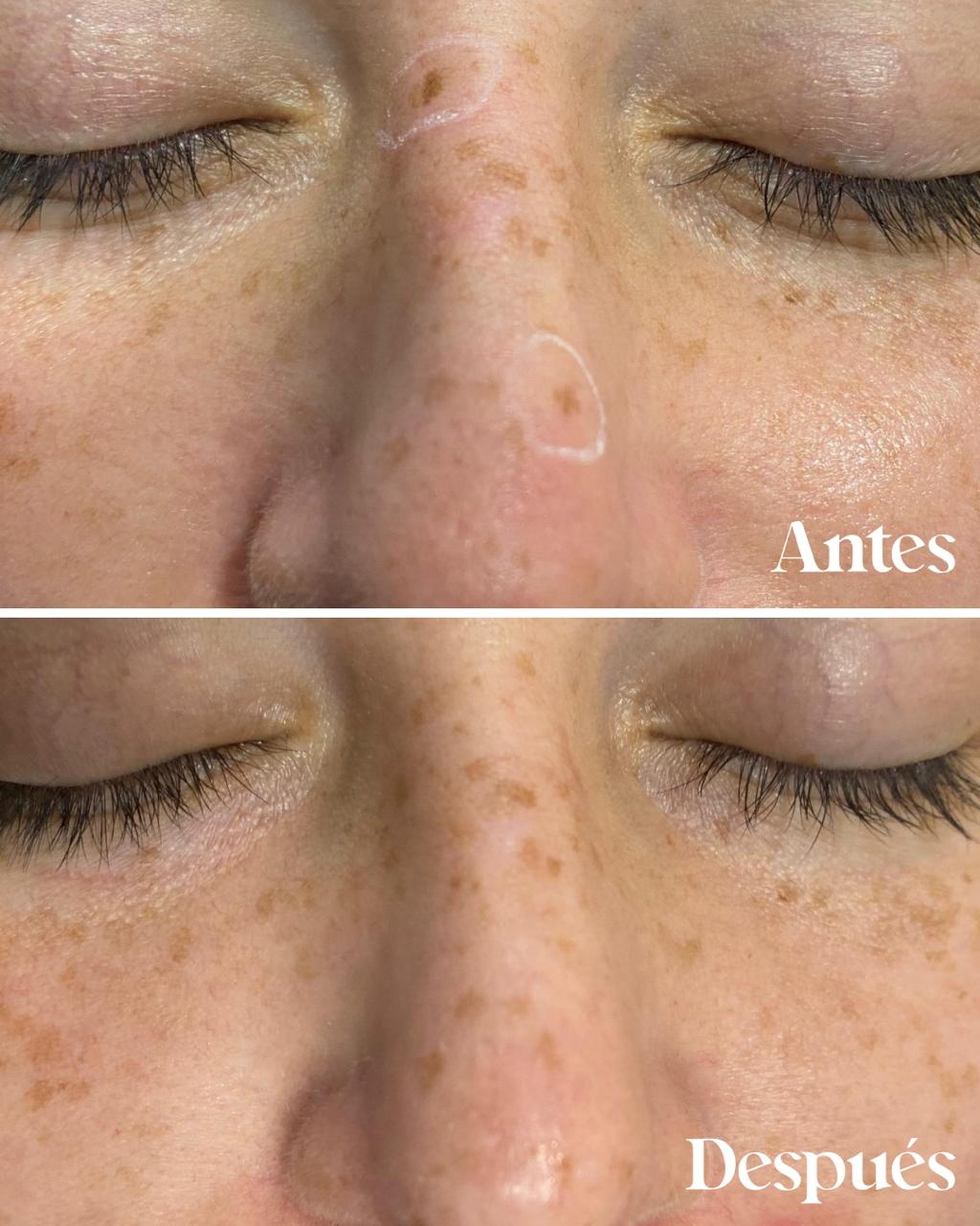 Antes y después de remoción de efélides (pecas) en el rostro con láser en SkinCenter Concepción
