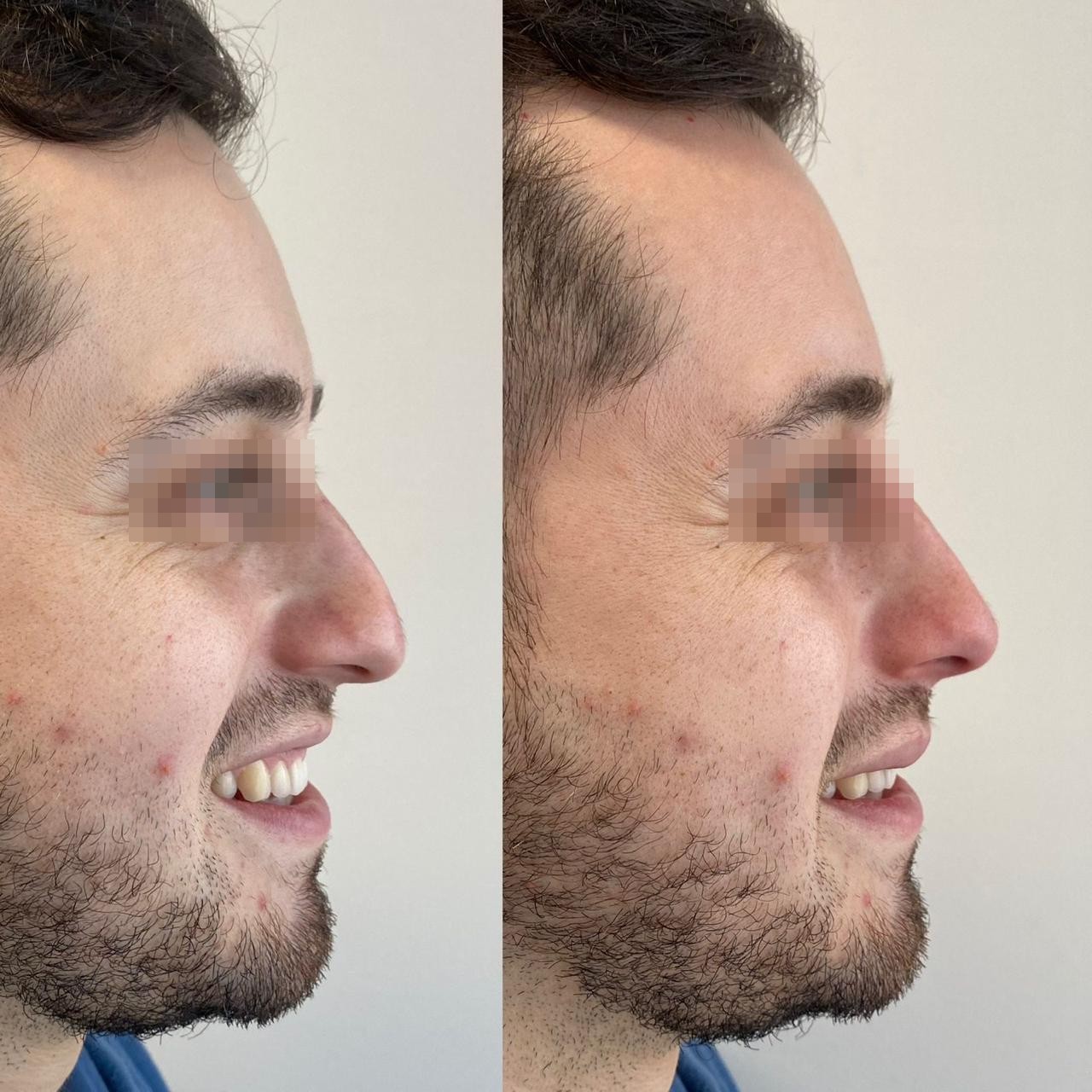 Antes y después de rinomodelación sin cirugía con ácido hialurónico, perfil masculino — SkinCenter Concepción