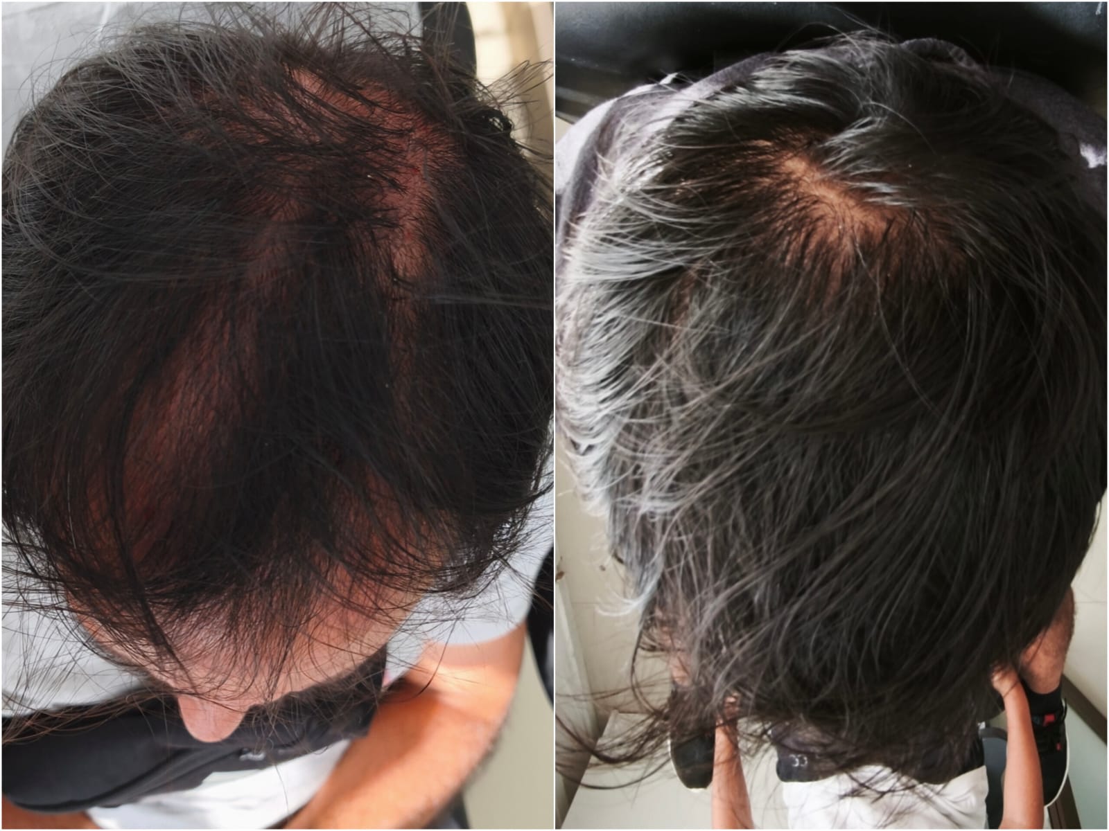 Tratamiento integral de alopecia androgenética antes y después, abordaje no quirúrgico — resultado del Dr. Georg Hübner