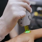 Láser Alexandrita de Candela en una sesión de depilación en SkinCenter Concepción