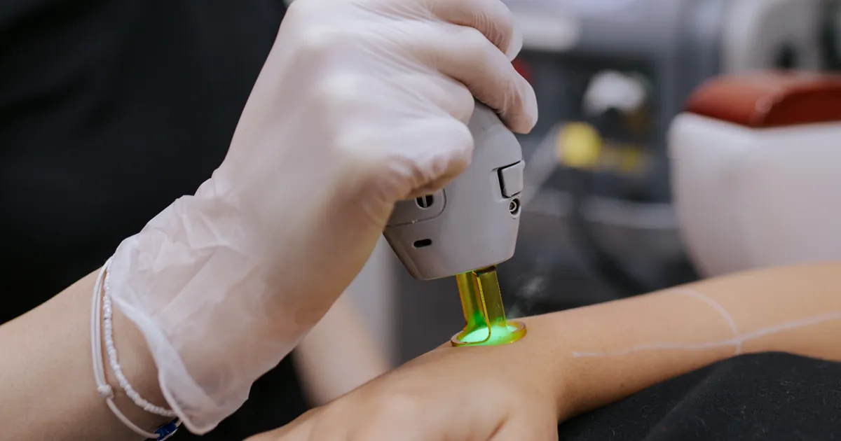Láser Alexandrita de Candela en una sesión de depilación en SkinCenter Concepción